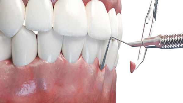 A Complete Guide To Gum Graft Surgery Chilecorrupcion