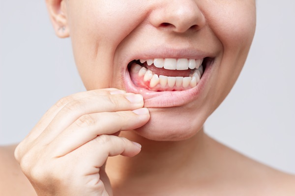 When To Visit A Periodontist For Gum Recession