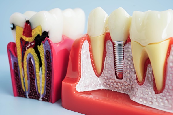 Transform Your Smile With Expert Implant Dentistry - Brighton ...