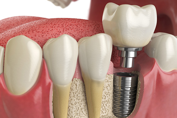 https://www.periocafe.com/wp-content/uploads/periodontist-explains-bone-graft-procedure.jpg